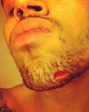 CB INJURY Four Female Victims Ready To Sue Over Chris Brown-Drake Fight